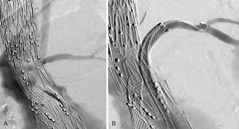 Multibranched Endovascular Repair Of Thoracoabdominal Aortic Aneurysm ...