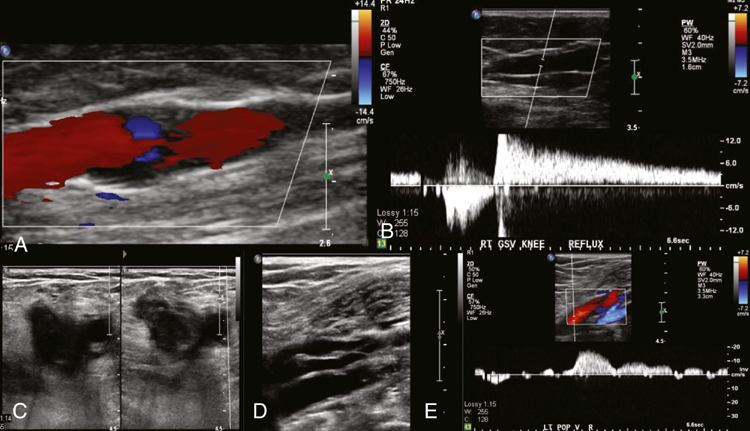 Ultrasonography for the Diagnosis of Venous Disease | Thoracic Key