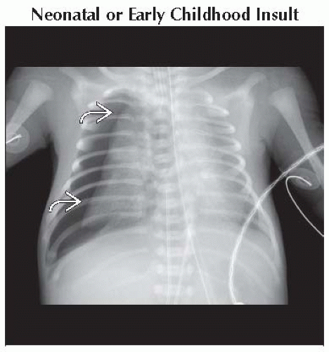 bell-shaped-chest-thoracic-key