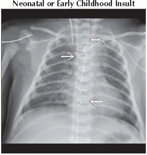 bell-shaped-chest-thoracic-key