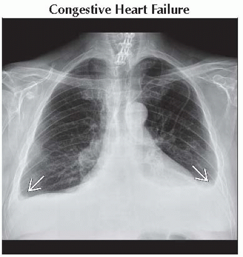 Bilateral Pleural Effusion Differential