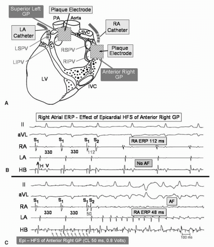 Ablation of Autonomic Ganglia | Thoracic Key