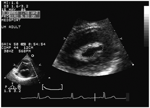 mitral-stenosis-thoracic-key