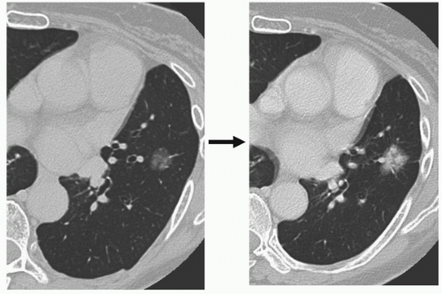 Management Of Ground-Glass Opacity Lesions | Thoracic Key