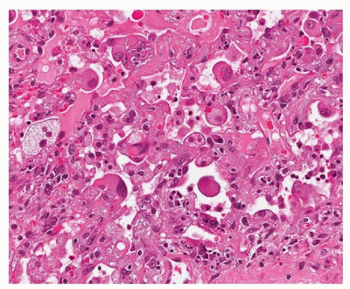 alveoli-in-the-lungs-have-type-i-pneumocytes-gas-diffusion-type-ii