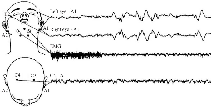 eeg sleep study