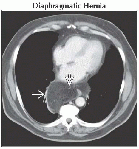 Low Attenuation Mass Mediastinum Or Hilum Thoracic Key 