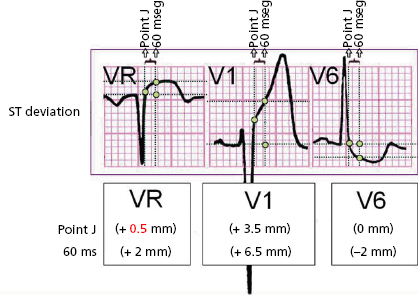 A: Follow-up electrocardiogram showing a 0.5 mm convex ST-segment