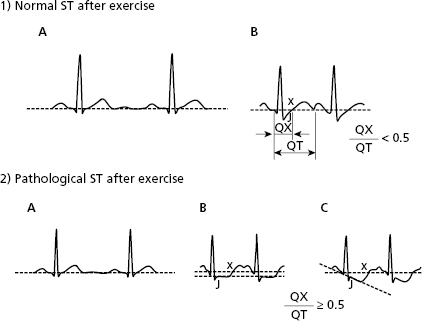 QRS Interval • LITFL • ECG Library Basics