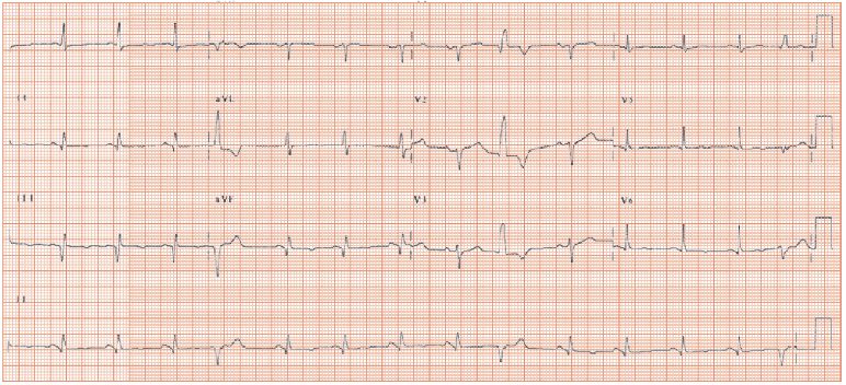 mild-t-wave-flattening-thoracic-key