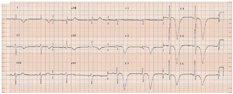 T Wave Inversion In Lateral Leads