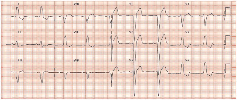 deep-t-wave-inversion-thoracic-key