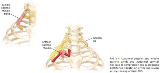 Thoracic Outlet Syndrome - ScienceDirect