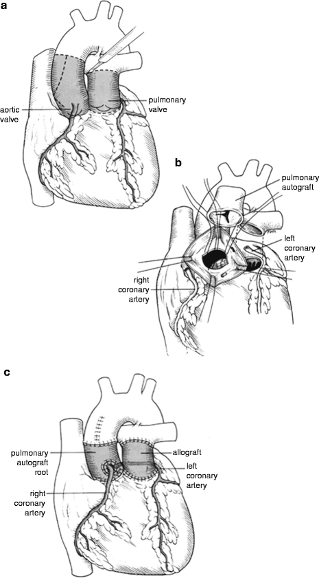 A217628_1_En_6_Fig2_HTML.gif