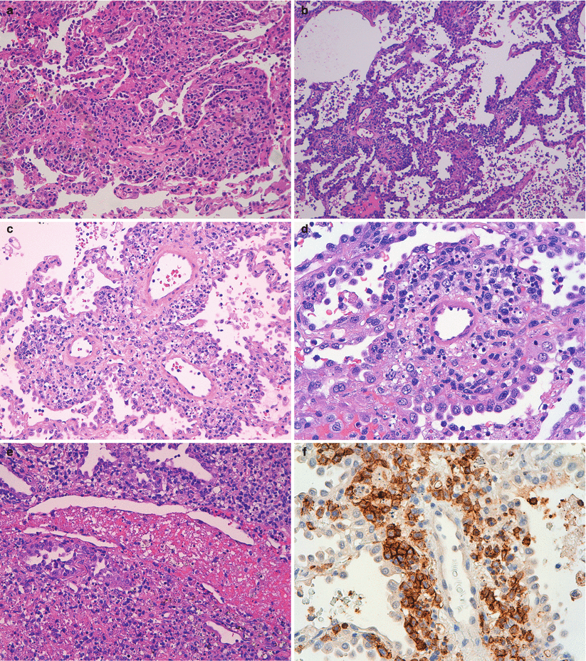 Lymphoproliferative Lung Disorders | Thoracic Key