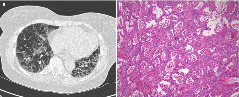 Pulmonary Manifestations Of Hematological Malignancies: Focus On ...