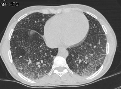 Niemann-Pick disease type B: HRCT assessment of pulmonary