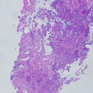 Malignant Tumors of the Lung in Small Lung Biopsies | Thoracic Key