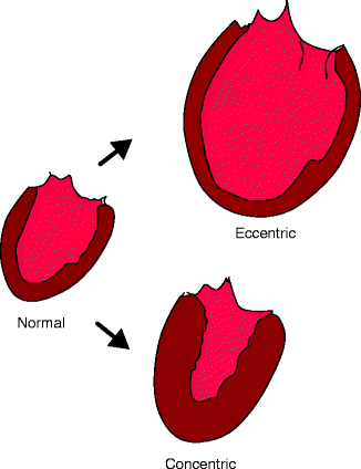 hypertrophy of the heart