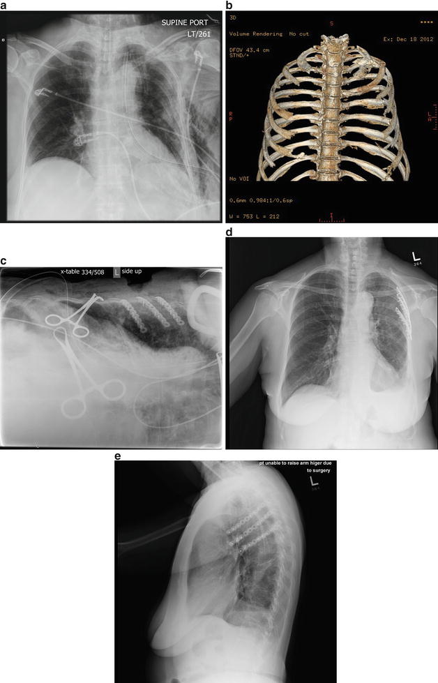 The Pathophysiology Of Flail Chest Injury | Thoracic Key