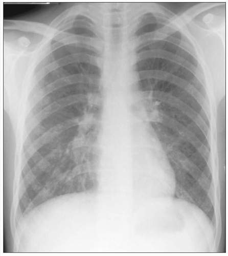 mycoplasma pneumonia chest x ray findings