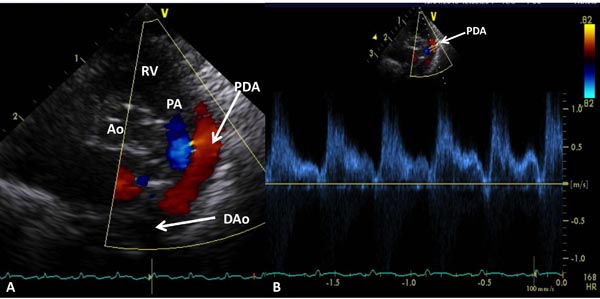 Echocardiographic Evaluation of Neonates with Suspected Heart Disease ...
