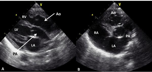 Transposition Of The Great Arteries Thoracic Key Transposition Of The Great Arteries Thoracic Key