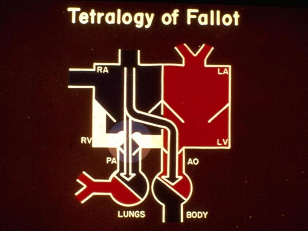 Tetralogy of Fallot | Thoracic Key