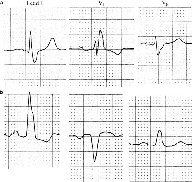 Bundle Branch Blocks And Hemiblocks Thoracic Key