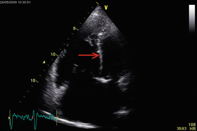Advanced Imaging In Pulmonary Hypertension Thoracic Key