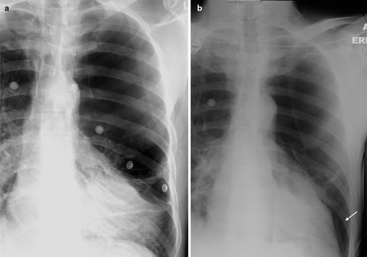 Image: Chest X-Ray of a Patient with Fluid in Minor and Major Fissures -  Merck Manuals Professional Edition