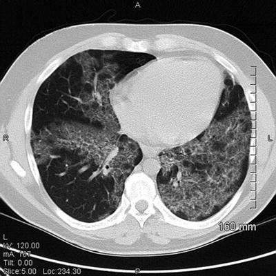 Whole-Lung Lavage | Thoracic Key