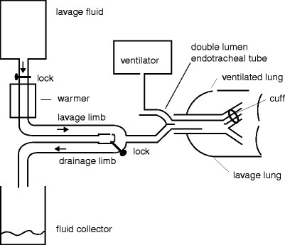 Whole-Lung Lavage | Thoracic Key