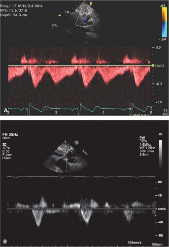 Right Ventricular Function And Pulmonary Hemodynamics | Thoracic Key