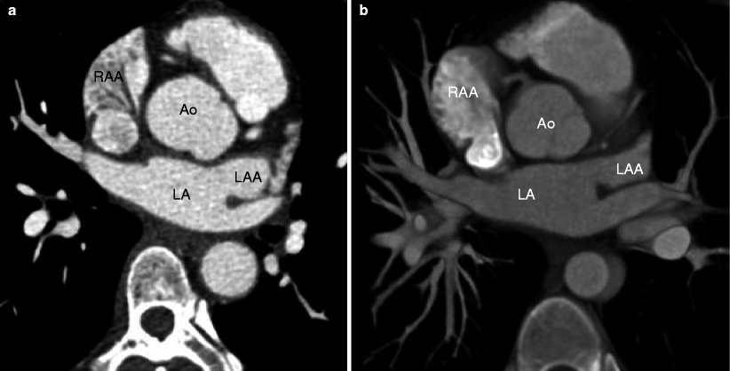 Heterotaxy Syndrome | Thoracic Key