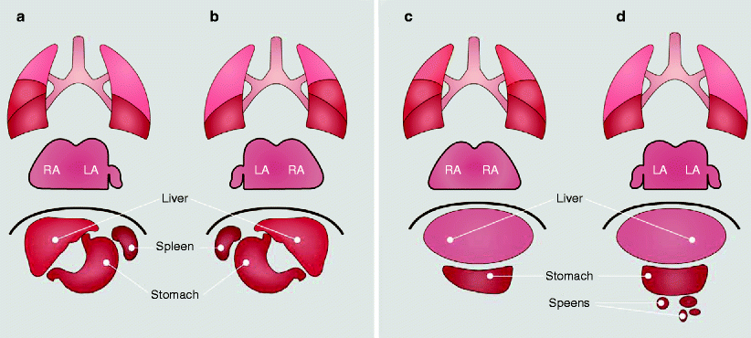 situs inversus ambigus adalah Basic Nomenclature in Adult Congenital Heart Disease 