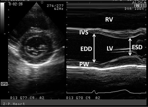 M-Mode LV function study-showing Global hypokinesia, Severe LV