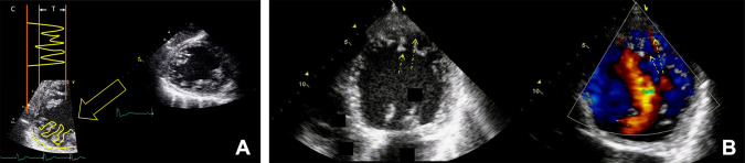 Estimation of Prevalence of the Left Ventricular Noncompaction Among ...