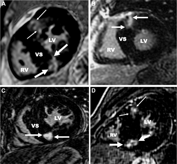 Significance of Late Gadolinium Enhancement at Right Ventricular ...