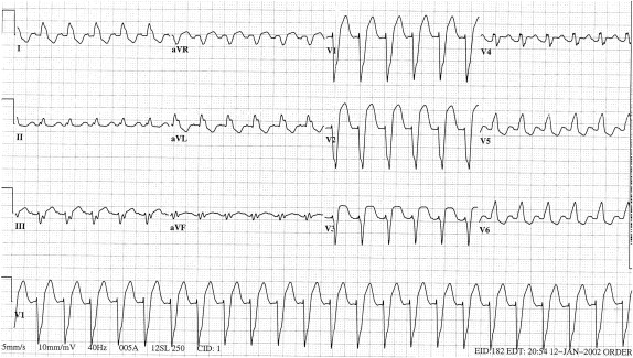 Chest Pain and a Wide QRS Tachycardia | Thoracic Key