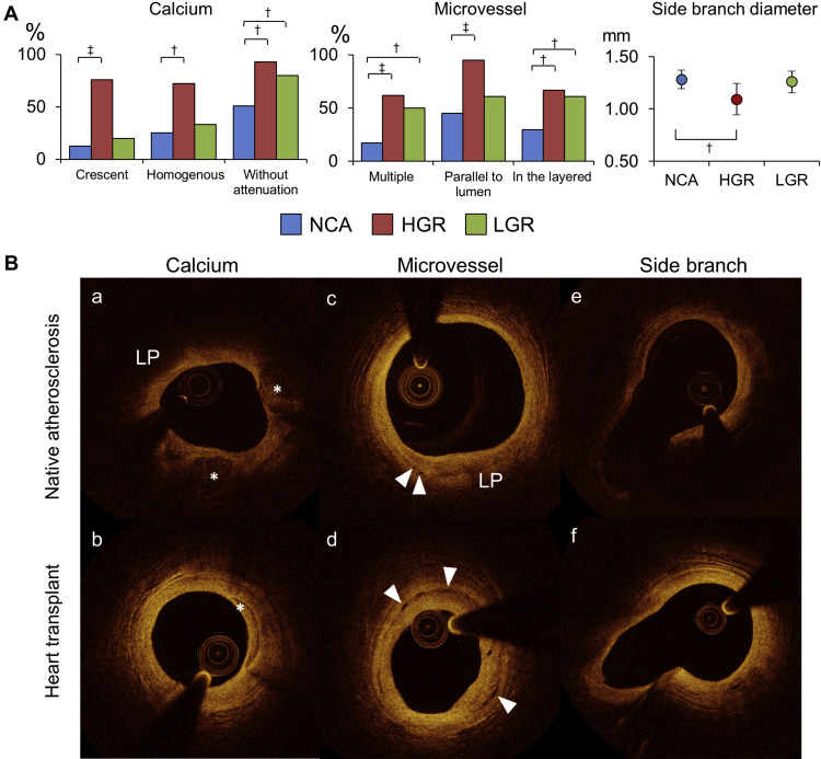 Comparison Between Cardiac Allograft Vasculopathy And Native Coronary ...