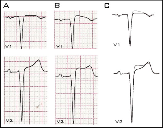 Brugada Syndrome Electrocardiographic Pattern as a Result of Improper ...