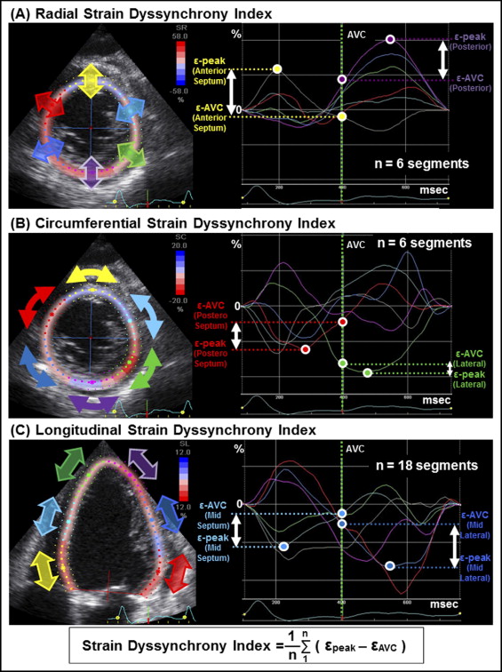 Strain Echocardiography by speckle tracking and tissue Doppler -Part  I:technique 