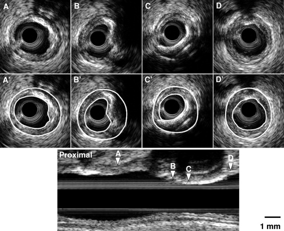 Histopathologic Validation Of The Intravascular Ultrasound Diagnosis Of ...