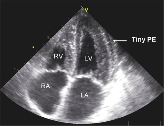 Echocardiographic Evaluation of Systolic and Diastolic Function in ...