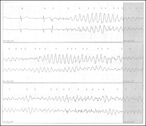 Self-Terminated Ventricular Fibrillation and Recurrent Syncope ...