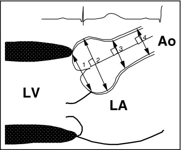 aortic root measurement