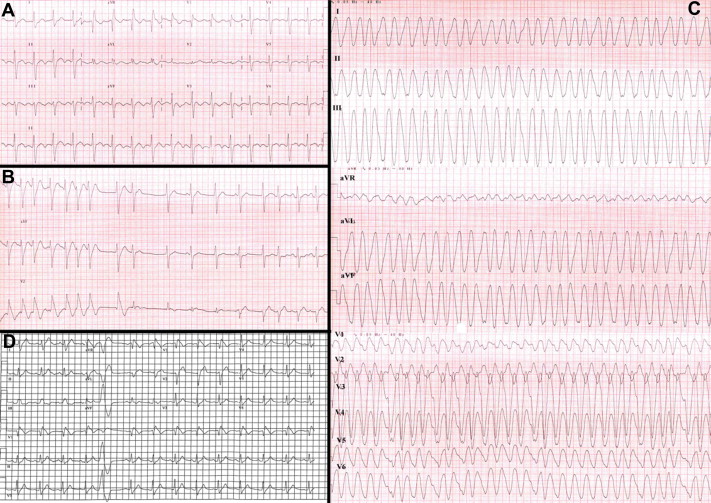 type ii atrial flutter icd 10