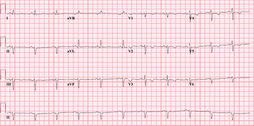 Arrhythmogenic Right Ventricular Dysplasia/Cardiomyopathy According to ...