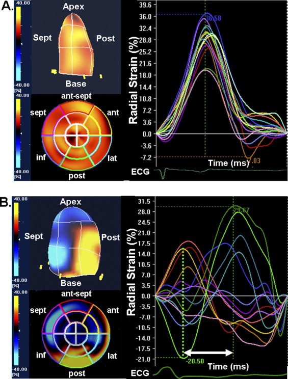 Color-coded polar diagram obtained by speckle-tracking echocardiography